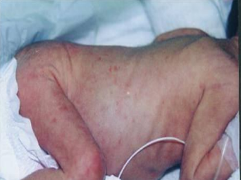 新生儿常见的皮肤问题